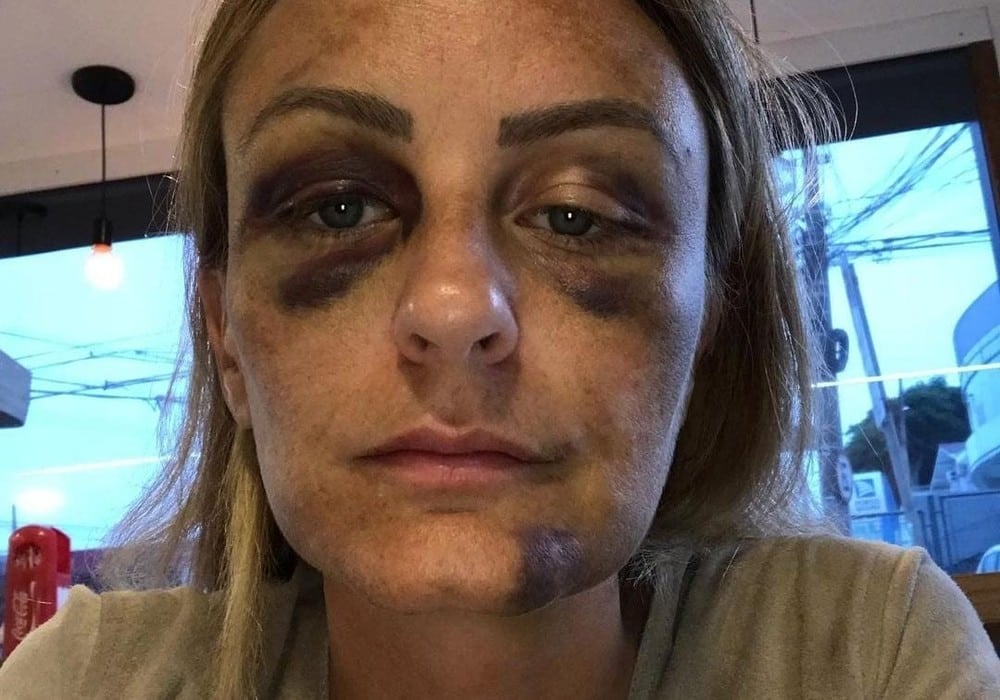 “Fiquei com tanta vergonha”; ex-namorada de surfista brasileiro que agrediu norte-americana revela agressões
