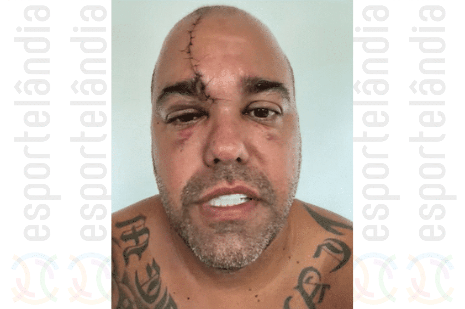 Bodyboarder sofre acidente gravíssimo e tem corte profundo na cabeça
