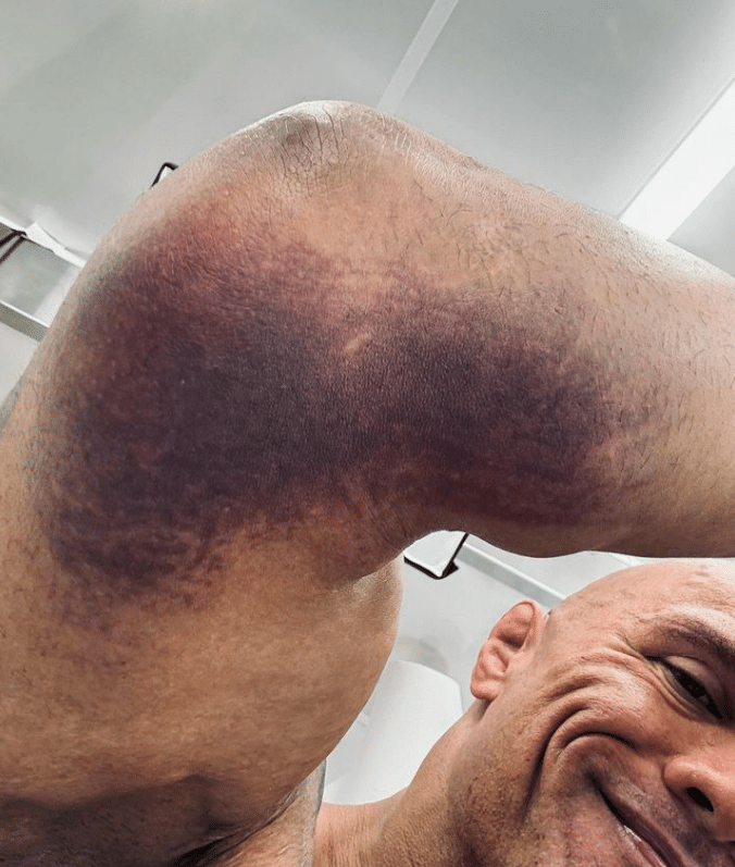 The Rock sofre grave les&atilde;o comum no fisiculturismo, entenda os detalhes