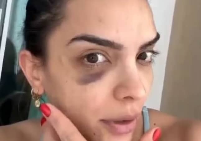 Natinha aparece de olho roxo e faz denúncia polêmica